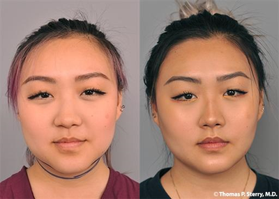 Woman treated with Chin Liposuction - This young woman came in originally asking for chin liposuction. After that procedure went well, she decided that she would like me to reduce the size of what she called her Chipmunk Cheeks. That procedure was performed a few months later.
