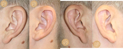 35-44 year old man treated with Ear Lobe Reduction Surgery - This is a gentlemen who has large earlobes (everyone in his family does).  I performed an earlobe reduction surgery on him under local anesthesia.