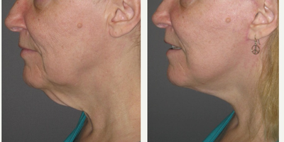 60 year old woman treated with Neck Lift - This young woman had lost over 100 lbs. over the year prior to her procedure.  As she lost weight, she noticed that her neck continued to sag just as quickly.  She consulted with our Center for a procedure that could tighten both the deflated skin and underlying muscle.  We performed a necklift in our Center comfortably under local anesthesia an mild oral sedation with valium.  Her results are quite dramatic, with creation of a profile and more definition along the jawline, all while keeping the appearance natural.