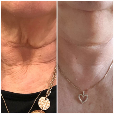 55-64 year old woman treated with Laser Treatment - Plasma Fibroblst (PlasmaLift) Neck