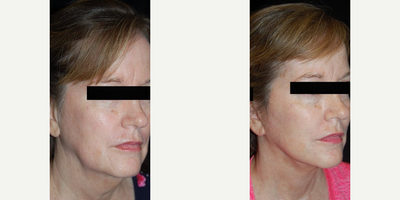 Woman treated with Neck Lift - Woman treated with Neck Lift