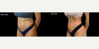 Woman treated with Brazilian Butt Lift, Liposuction - Abdominal Liposuction & BBL