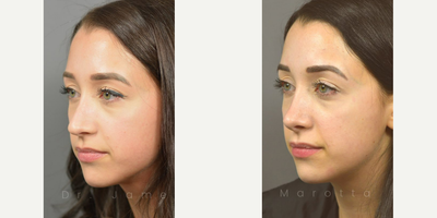 Woman treated with Revision Rhinoplasty - We checked in with this patient at her 6 month Post-Op appointment -- here's how she's doing now at 1 year.Revision Rhinoplasty is a surgery is used to repair undesirable effects from a previous nose job, most often with another physician. Not all plastic surgery procedures provide the results you desire, whether because the surgeon is inexperienced or unforeseen complications may arise. Revision rhinoplasty works to correct these undesired effects as much as possible, sometimes by grafting ear or rib cartilage if there isnt enough septal cartilage present to support the nasal structure. Revision rhinoplasty can be very complex  depending on the amount of scar tissue present and the preservation of the original nasal structure  and can last up to five hours. The risk of needing revision rhinoplasty is significantly reduced by seeing a board-certified facial plastic surgeon in the first place, so it is vital that you do your due diligence when choosing your surgeon.