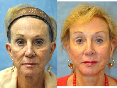 74 Year Old Female treated for Unacceptable Cosmetic Appearance of the Face - Fat Transfer/Grafting to cheeks, nasolabial folds and marionette lines