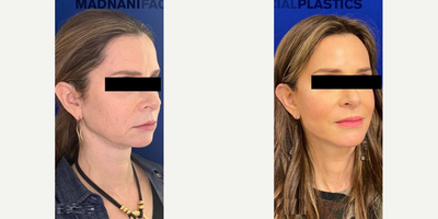 57 year old woman treated with Mini Facelift - 57 year old patient with 3.5 months post-op treated with mini facelift, neck lift, lower blepharoplasty, skin pinch, fat transfer with nano fat and CO2 laser.