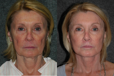 Lip Repositioning - Lip Lift + Deep Plane Facelift