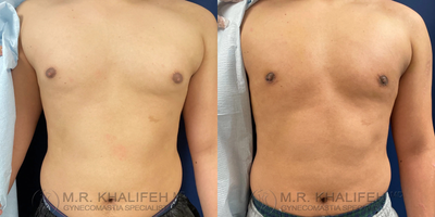 Man treated with Gynecomastia Surgery - A small amount of glandular tissue was removed in this patient to accentuate his chest.