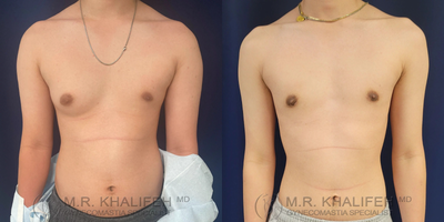 Man treated with Gynecomastia Surgery - This is a young man with unilateral gynecomastia where the right side was way overdeveloped. Because we had some breast tissue on the left, I went ahead and removed both sides (which is the usual case). This case was done under local anesthesia. The results are shown about three months later.