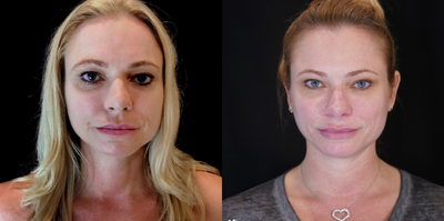 35-44 year old woman treated with Microneedling - Patient received microneedling with PRP