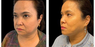 55-64 year old woman treated with Nonsurgical Facelift, Renuvion for Facial Resurfacing - Patient: Female, 59Procedure: Renuvion Mini FaceliftRecovery: 9 months