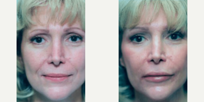 Woman treated with Facial Fat Transfer - Woman treated with Facial Fat Transfer