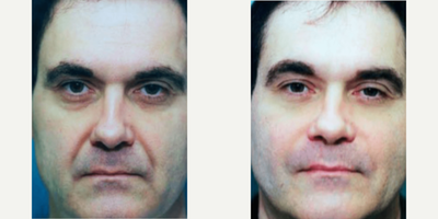 Man treated with Facial Fat Transfer - Man treated with Facial Fat Transfer