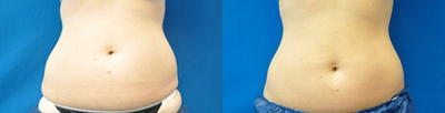 Liposonix - 
	Liposonix
