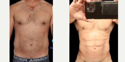 45-54 year old man treated with Abdominal Etching, Liposuction, SAFELipo, Liposculpture, Power-Assisted Liposuction (PAL), Tumes - Great contour and abdominal definition.