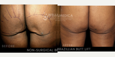 65-74 year old woman treated with Nonsurgical Butt Lift - 3 Month post non-surgical BBL treatment