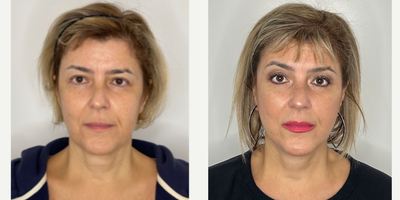 55-64 year old woman treated with Facelift, Neck Lift, CO2 Laser - 56 year old patient 8 months after Facelift, Neck lift and CO2 laser