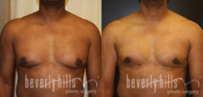 Gynecomastia - Gynecomastia
