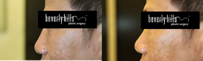 Non Surgical Rhinoplasty with Radiesse - Radiesse injected to raise the bridge of the nose.