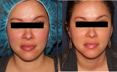 Uneven skin tone treated with PicoWay laser - 2 months following the removal of a red tone on the patient's cheeks with the PicoWay laser.