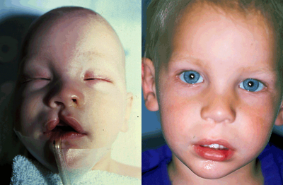Cleft Lip Repair - 
	Cleft Lip Repair
