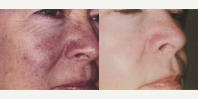 Woman treated with Pulsed Dye Laser - Woman treated with Pulsed Dye Laser