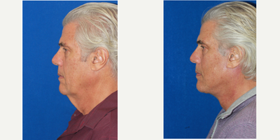 65-74 year old man treated with Deep Plane Facelift, Neck Lift - This male patient presented to us with face and neck skin laxity. He has developed deep skin folds, loss of jawline contour and extensive sagging in the neck, which all contributed to an overall aged facial appearance. A comprehensive surgical plan for this patient included a deep plane facelift and neck lift to address his concerns. The deep plane facelift and neck lift surgery helped this patient achieve an effective and natural-looking transformation. He looks more youthful and rejuvenated.