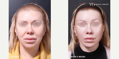55-64 year old woman treated with Facelift, Neck Lift, Brow Lift, Lip Surgery - 5564 year old woman treated with facelift, neck lift, brow lift, lower eyelid surgery (lower blepharoplasty), platysma plication (platysma muscle tightening), and upper lip lift (philtrum reduction).