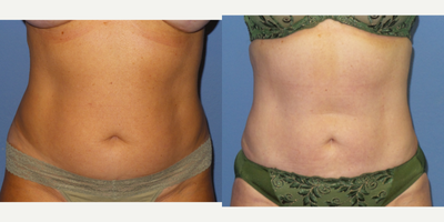 45-54 year old woman treated with Smart Lipo - 50 y/o female 2 months s/p SmartLipo to abdomen and flanks.