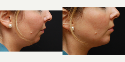 25-34 year old woman treated with Ellanse for chin augmentation - This 27yr old patient was born without full development of her chin which make the appearance of her face shorter and wider. By using Ellanse to restore the volume of the chin a more aesthetic shape of her face is restored and there is an improvement of her jawline profile and neck. Older patients will often benefit from chin and jawline augmentation which occurs due to the loss of bone associated with ageing, which will exacerbate the appearance of the jowl and laxity in the upper neck. The results of Ellanse can last over 4 years following treatment.