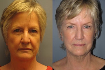 LiteLift, Brow Lift, Fat Transfer Liposuction Under Chin on 68-year-old Woman - This 68-year-old woman had a LiteLift&trade;, Temple Brow Lift, and Liposuction of the Neck. T A Temple Brow Lift brightened the eye area, adding to her rested new look. Fat transfer was used on her marionette lines. Liposuction of the neck adds to contour, and redefines her jaw line.