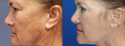 Woman treated with Eyelid Surgery - Woman treated with Eyelid Surgery