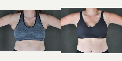 45-54 year old woman treated with Breast Reduction of the Axilla Tissue - This 45-year-old patient underwent a unique procedure that removed breast tissue that had formed in the axillary or underarm area. The post-operative photos were taken three months after the surgery, showcasing the impressive results.If you're interested in achieving your ideal appearance, we invite you to request a consultation to learn more about this transformative procedure. Don't forget to bring your favorite photos to help communicate your goals and expectations.It's important to keep in mind that each patient is unique and results may vary. The pictures displayed are of a real patient who has given their consent to share their experience online.