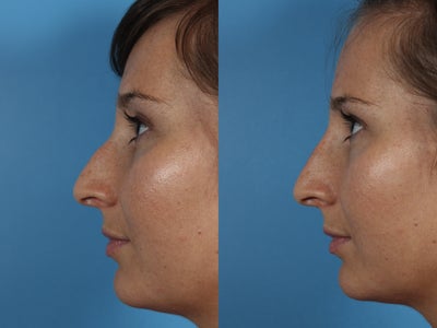 Non-surgical Rhinoplasty - A non-surgical nose job can be performed with a filler such as Restylane or Juvederm. The filler needs to be carefully injected in the correct locations to help achieve better balance to the nose. In this case, a dorsal hump would be best corrected by a rhinoplasty. Instead of surgery, this patient chose to have a nonsurgical rhinoplasty which will last for approximately one year. There is no downtime and the dorsal hump is smoothed out giving a softer appearance to the nose.