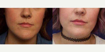 Woman treated with Chin Surgery - Woman treated with Chin Surgery for reduction
