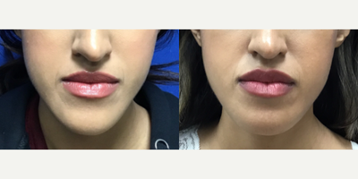 Woman treated with Chin Surgery - Woman treated with Chin Surgery for reduction