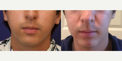 Man treated with Chin Surgery - Man treated with Chin Surgery using implant