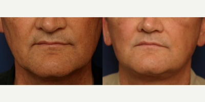 Man treated with Chin Surgery - Man treated with Chin Surgery for reduction
