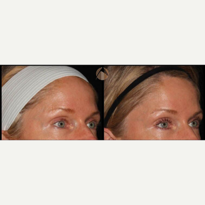 Woman treated with CO2 Laser - CO2RE, Fractional CO2 Resurfacing treatment