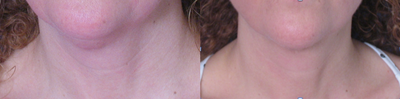 TriPollar - 
	Neck and double chin skin tightening after 6 treatments. Photos supplied by manufacturer, Pollogen Ltd, All Rights Reserved.
