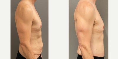 55-64 year old man treated with Male Tummy Tuck - 56 yo male s/p abdominoplasty without muscle tightening performed in our on site AAAA certified operating suite.