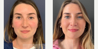 Woman treated with Alarplasty - Septoplasty with alar base reduction.The rhinoplasty also let the underlying features shine, rather than being hidden by the previous nose.