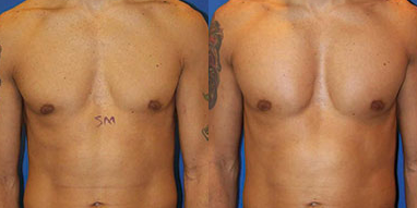 Pec Implants - 40 year old male 2 weeks after Pec Implants using the vertical-rectangular type for more superior chest fullness.