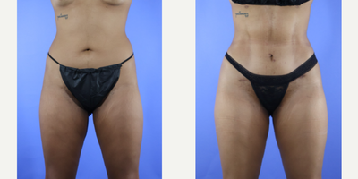 35-44 year old woman treated with Mini Tummy Tuck, Liposuction, Brazilian Butt Lift - Patient is 3 months post mini tummy tuck, liposuction 360 and fat transfer to buttock and hips. Patient has always been petite, but wanted an hour glass shape. Her results look natural and suit her body. She couldn't be happier with her results. She looks amazing!
