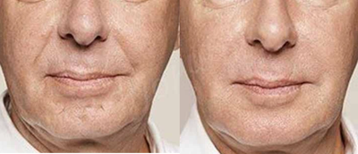 Patient treated with Bellafill - Patient treated with Bellafill to nasolabial folds and marionette lines