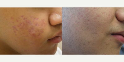 Acne with Isotretinoin, Scars with eMatrix - Tremendous improvement both in acne and scarring on a short 4 month course of low dose isotretinoin and 4 treatments with eMatrix Radiofrequency device.  Note the safety and effectiveness in darker skin-types also.