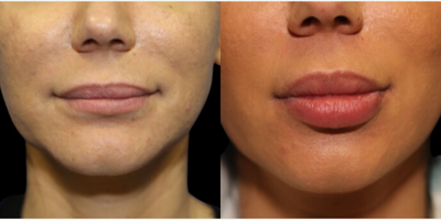 Woman treated with Lip Fillers - Woman treated with Liposuction
