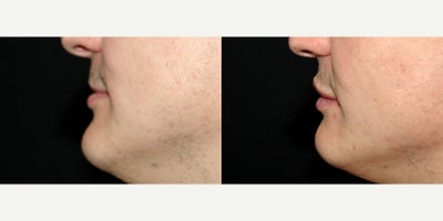 34 year old man treated with Lip Implants - 34 year old man treated with Lip Implants. Photos depict before and 1 month after surgery.