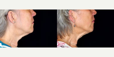 60 year old woman treated with Ultherapy to lower face and neck. - 60 year old woman treated with Ultherapy to lower face and neck. Photos depict before and 3 months after treatment.