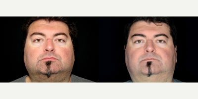 52 year old man treated with IPL for Rosacea - 52 year old man treated with IPL for Rosacea.