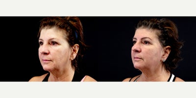 57 year old woman treated with Thread Lift - 57 year old woman treated with Thread Lift. Photos depict before and 1 month after 8 Silhouette Instalift Sutures.